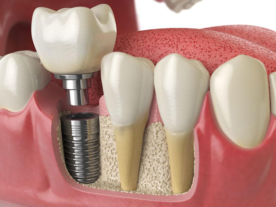 dental implant restorations in Blue Bell, PA